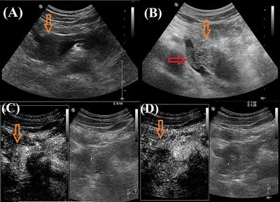 Contrast-enhanced ultrasound of pancreatic melanoma: A case report and literature review